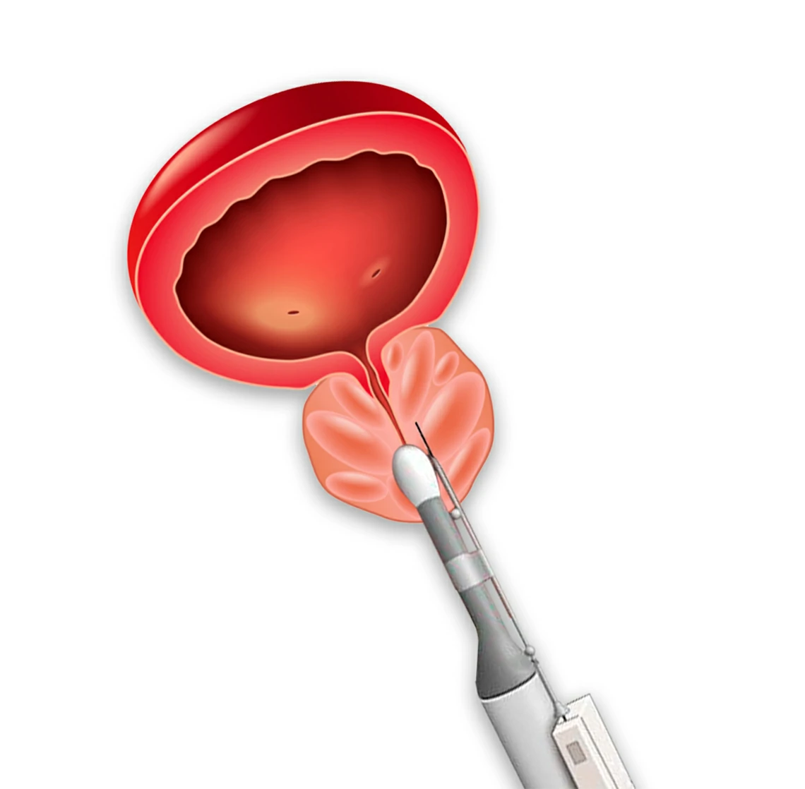 biopsia de prostata